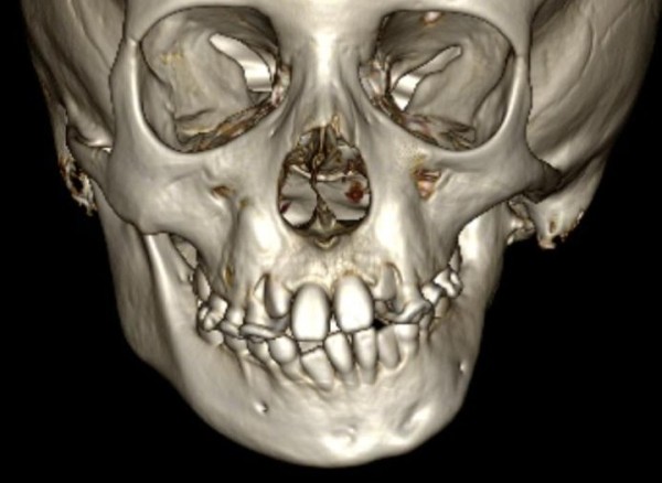 В стране впервые провели операцию пациентке с синдромом Гольденхара. Рассказываем, что это за болезнь В стране впервые провели операцию пациентке с синдромом Гольденхара. Рассказываем, что это за болезнь