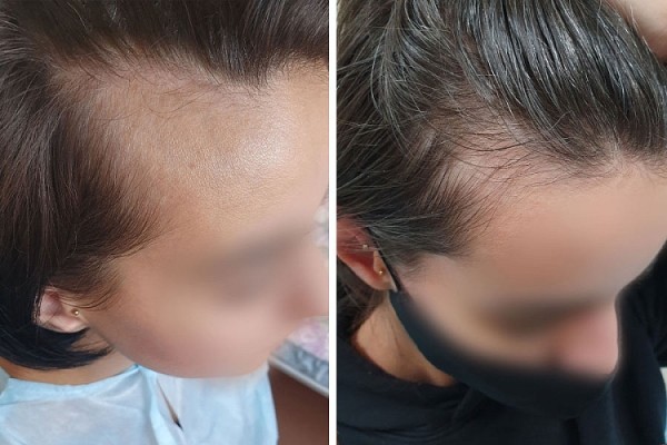 Как белорусы пересаживают волосы Как белорусы пересаживают волосы