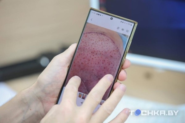 Как белорусы пересаживают волосы Как белорусы пересаживают волосы