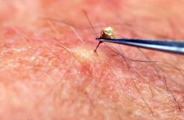 Житель Каменецкого района умер от укуса жалящего насекомого