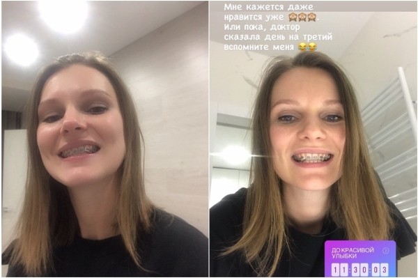 Потратил на зубы $15 тысяч — это того стоило? Белорусы, которые решились на брекеты во взрослом возрасте Потратил на зубы $15 тысяч — это того стоило? Белорусы, которые решились на брекеты во взрослом возрасте