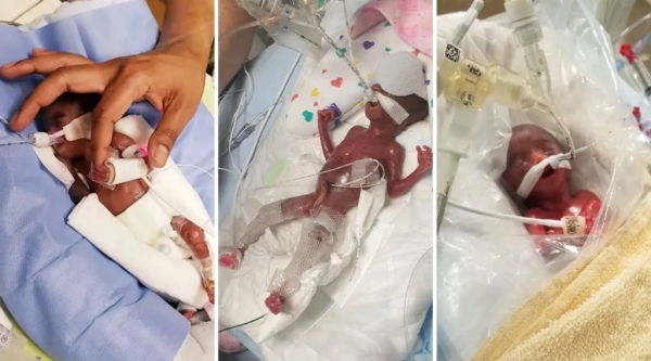 «Шанс на выживание — 0%». Эти близнецы считаются самыми недоношенными в мире «Шанс на выживание — 0%». Эти близнецы считаются самыми недоношенными в мире